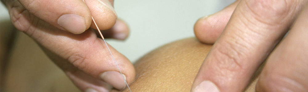 Physiotherapist using acupuncture on a patient